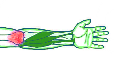 Referred Pain into the Elbow